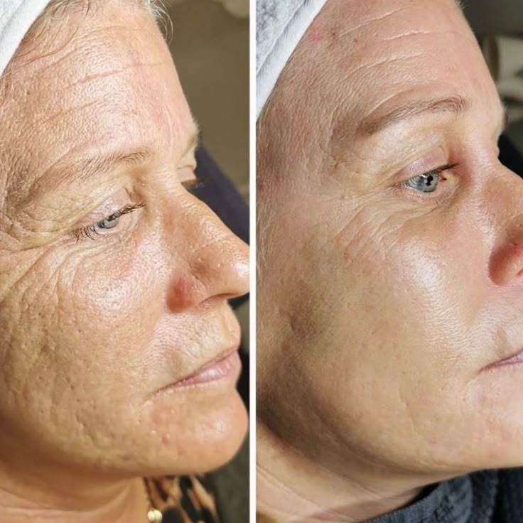 Qu’est-ce qui est mieux : le HIFU ou le microneedling ?