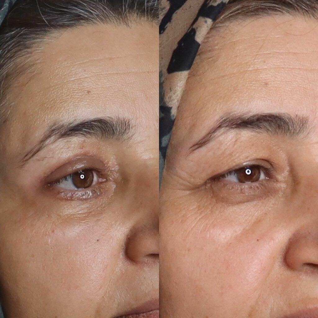 HIFU visage : avant/après, résultats et bienfaits du lifting sans chirurgie